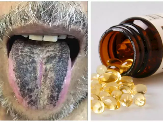 From a man with a black, hairy tongue to a vitamin D overdose, here are 3 fascinating medical cases from 2022 | Business Insider