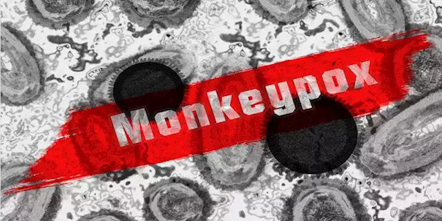 Limpopo reports first Monkeypox case - SABC News - Breaking news, special reports, world, business, sport coverage of all South African current events. Africa's news leader.