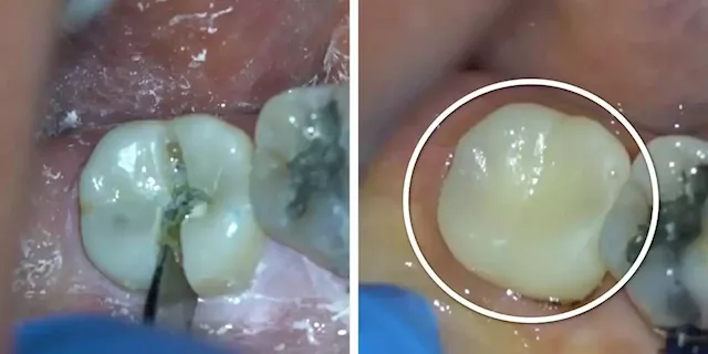 Revealing photos show how a dentist treats a cavity, from slicing and drilling to building the tooth anew | Business Insider