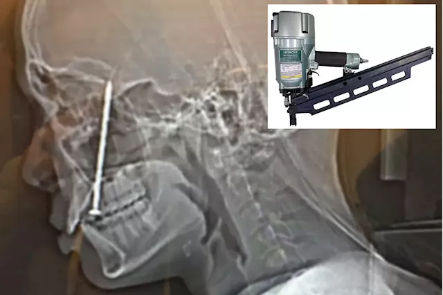 Carpenter sues power tool company after nail fired through his tongue and into skull