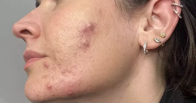 Irish mum was 'embarrassed' by severe acne that impacted her business until she found a solution