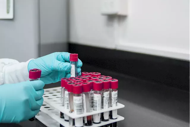 Dallas cancer tech company develops new blood test it says can catch tumors early