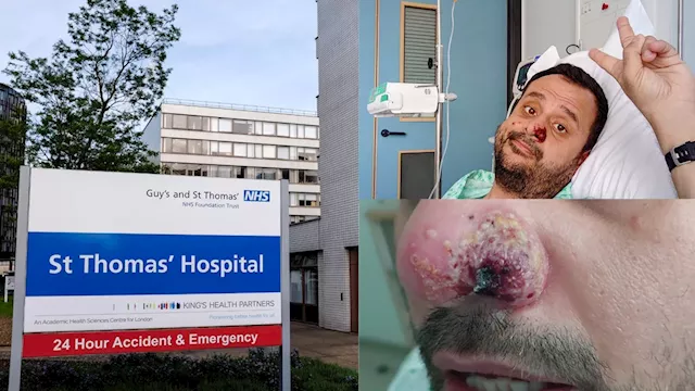 'Business as usual': Top London hospital cutting vaccinators in 'gobsmacking move' despite Mpox surge